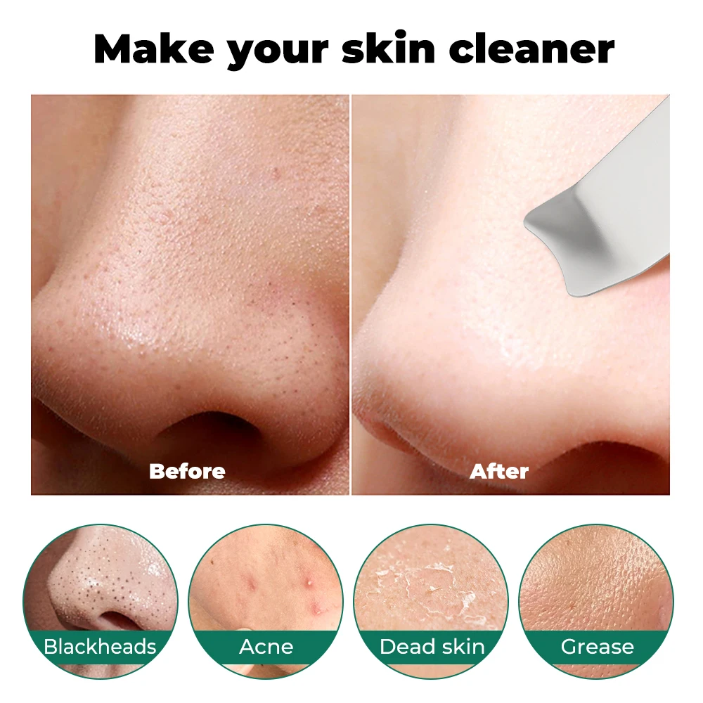 Ultrasonic Skin Scrubber Peeling Blackhead Remover Deep Face Cleaning Ultrasonic Ion Ance Pore Cleaner Facial Shovel Cleanser